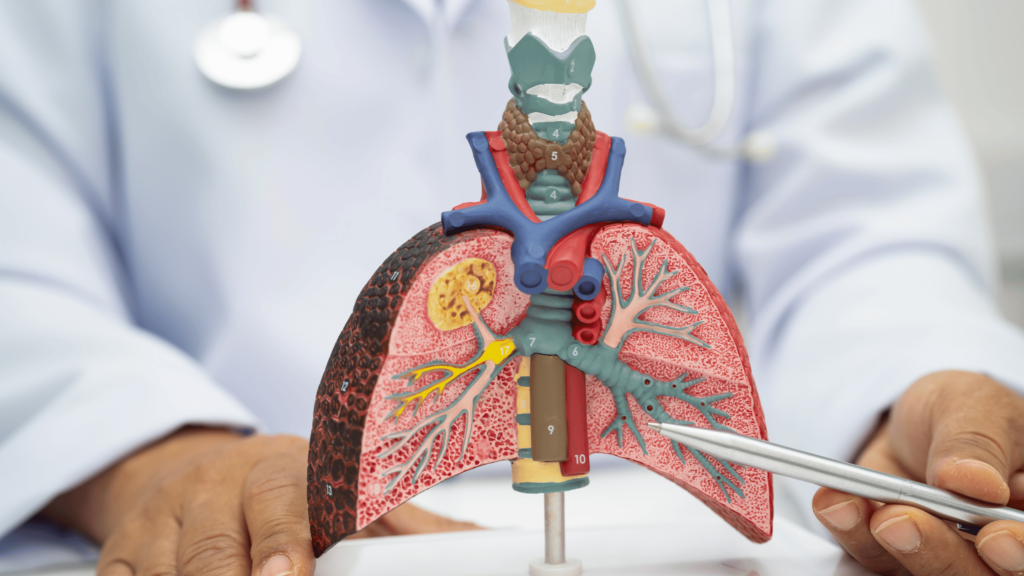 Lung Cancer