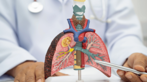 Osimertinib Tagrisso for Lung Cancer
