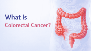 Colorectal Cancer