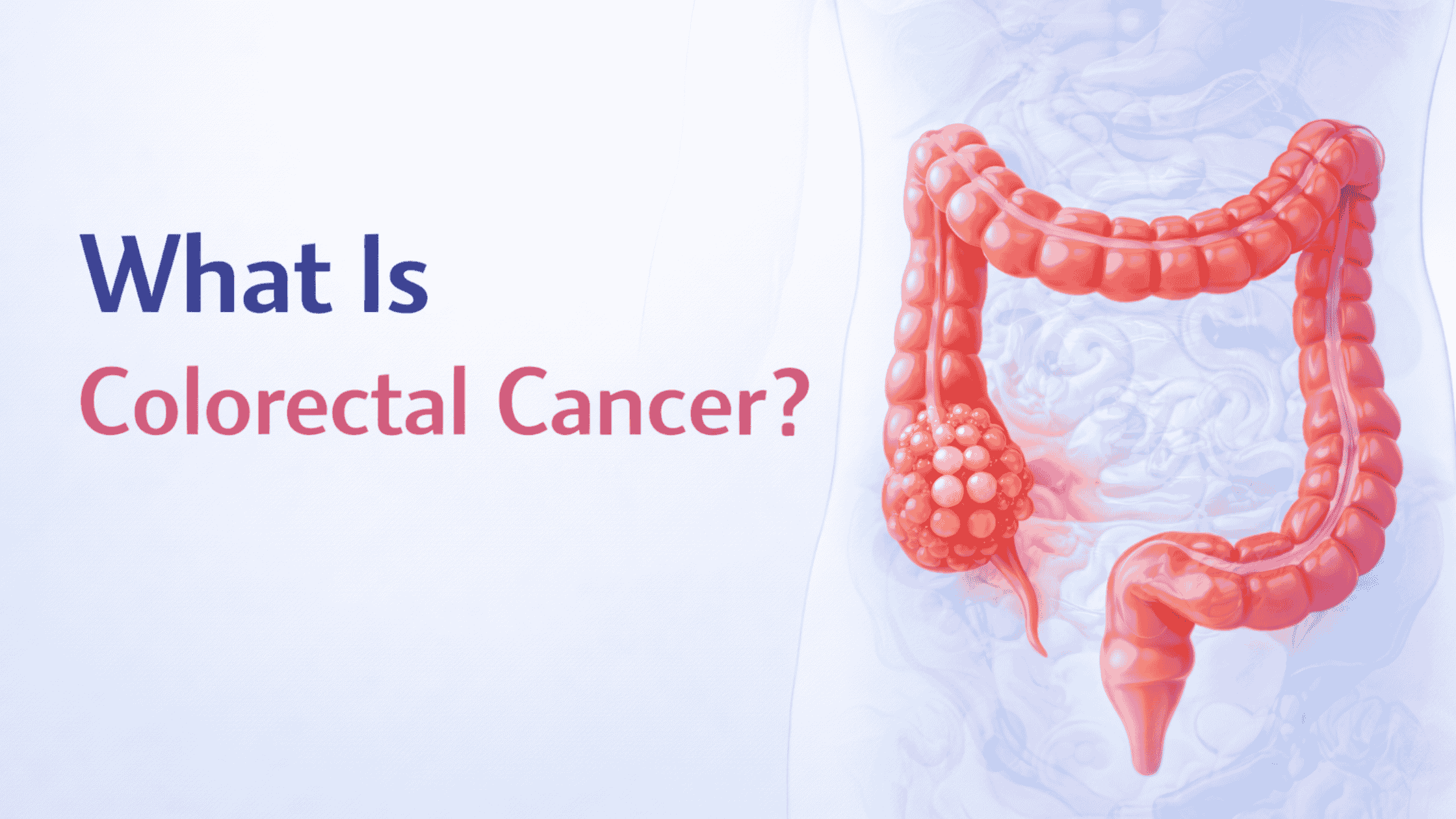 Colorectal Cancer